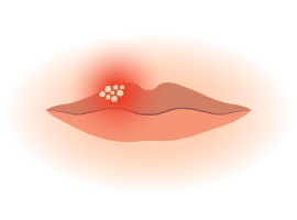 graphic of blistered lips