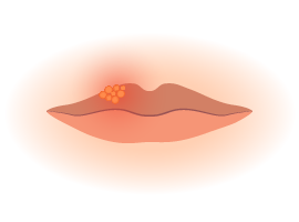 graphic of blistered lips