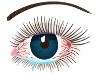 A red, watery eye irritated by allergens