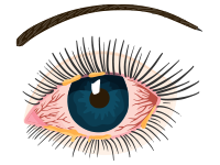 A red, crusty eye suffering from a bacterial eye infection