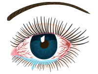 A red, watery eye irritated from exposure to chemicals