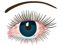 a red, watery eye suffering from a viral infection